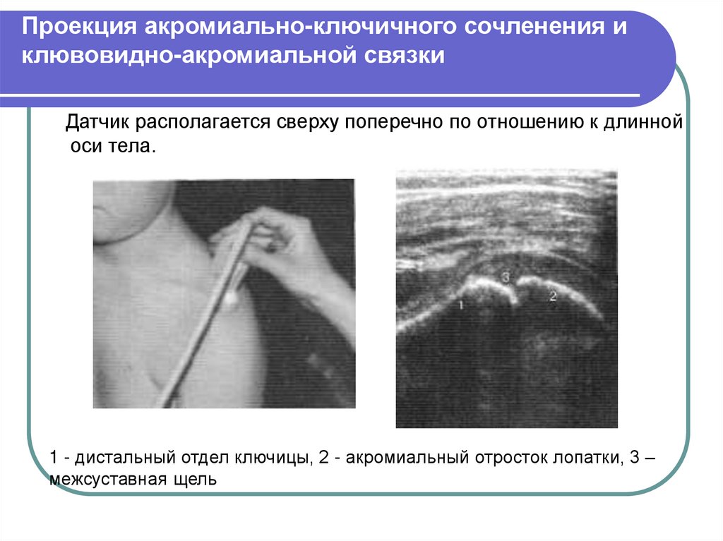 Акромиально ключичное сочленение норма. Связки акромиально-ключичного сочленения. Разрыв ключичного сочленения. Дистальный отдел ключицы. Акромиально-ключичное сочленение УЗИ.