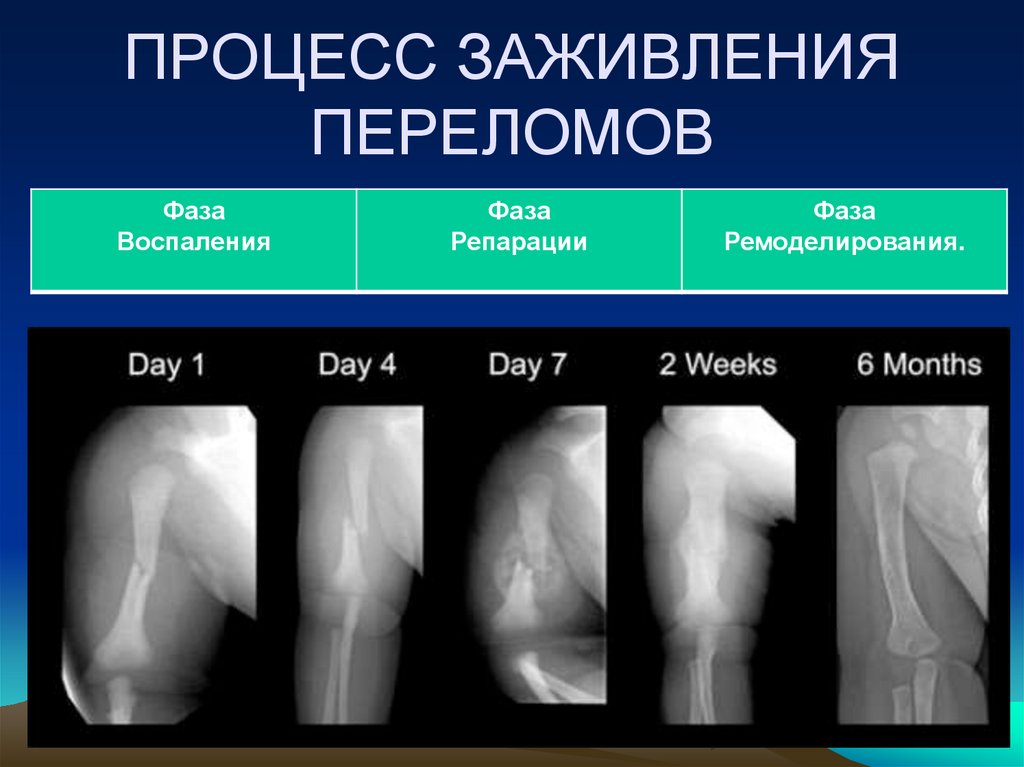 Сколько заживает перелом