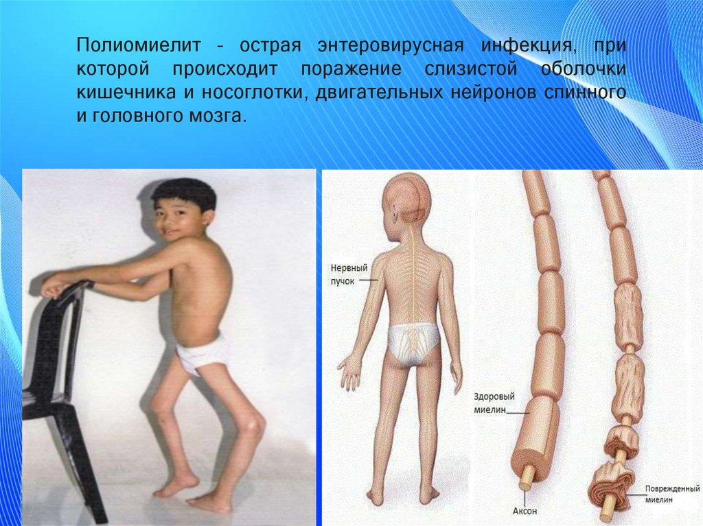 Полиомиелит – острая энтеровирусная инфекция, при которой происходит поражение слизистой оболочки кишечника и носоглотки,