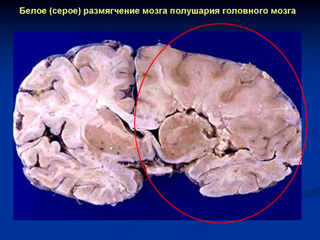 Белое (серое) размягчение мозга полушария головного мозга