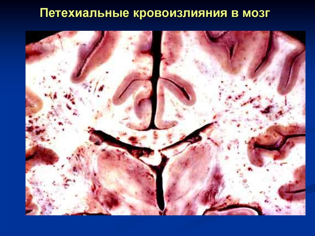 Петехиальные кровоизлияния в мозг
