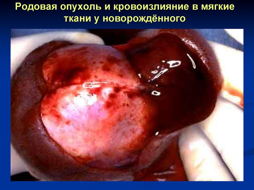 Родовая опухоль и кровоизлияние в мягкие ткани у новорождённого