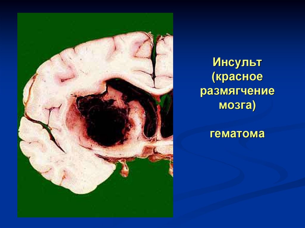 Инсульт (красное размягчение мозга) гематома