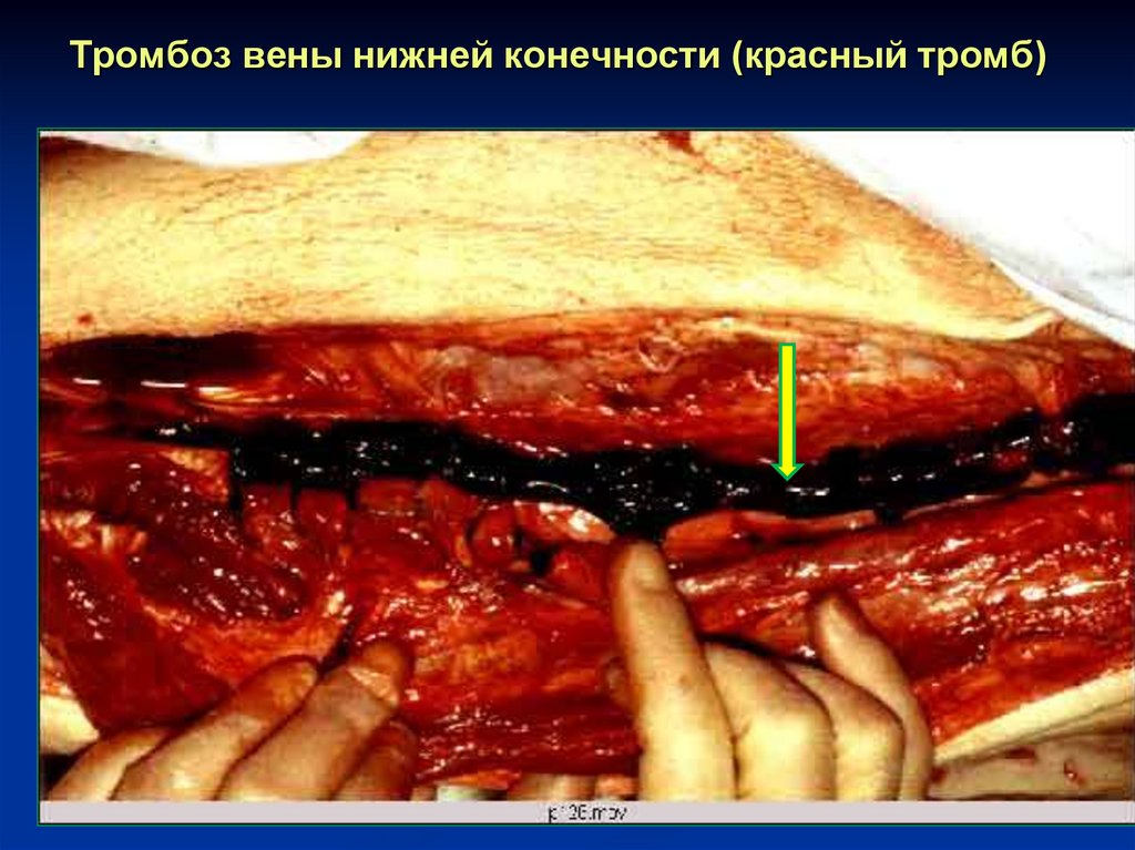 Тромбоз вены нижней конечности (красный тромб)