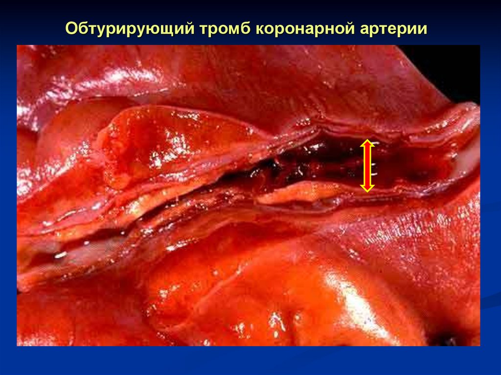 Обтурирующий тромб коронарной артерии