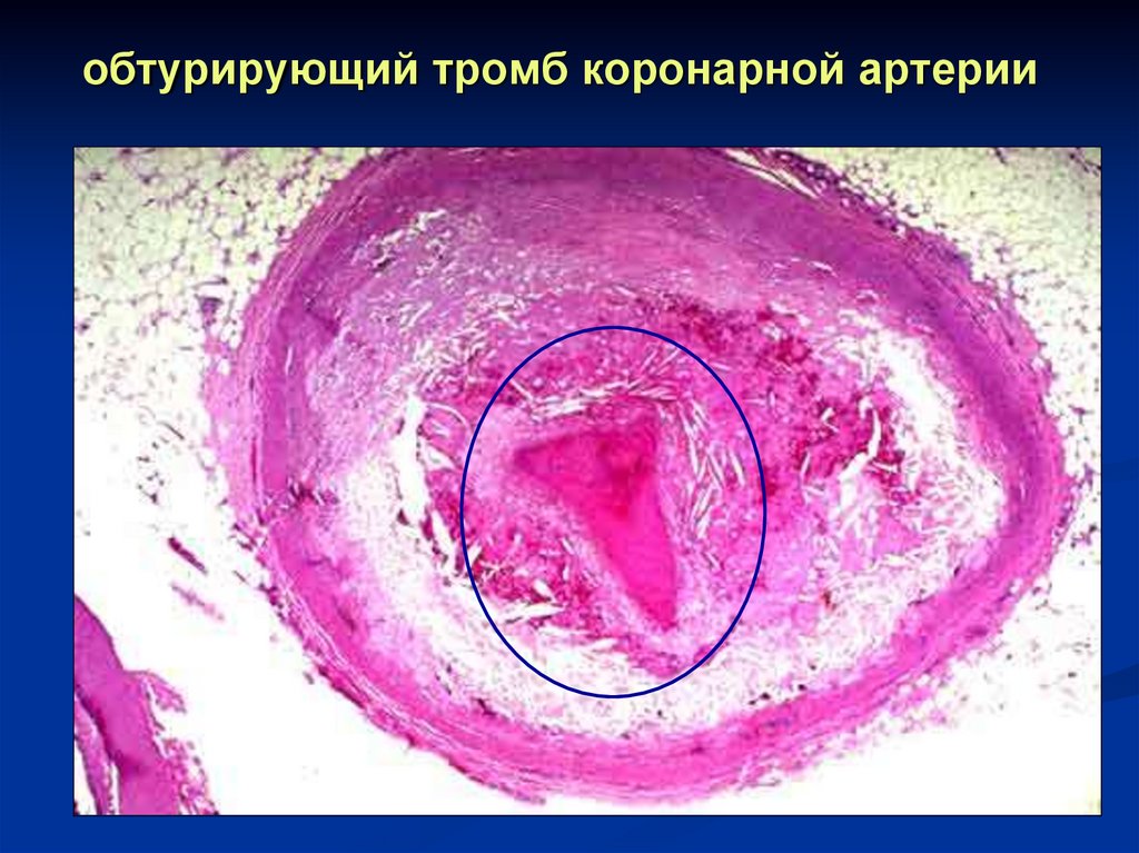 обтурирующий тромб коронарной артерии