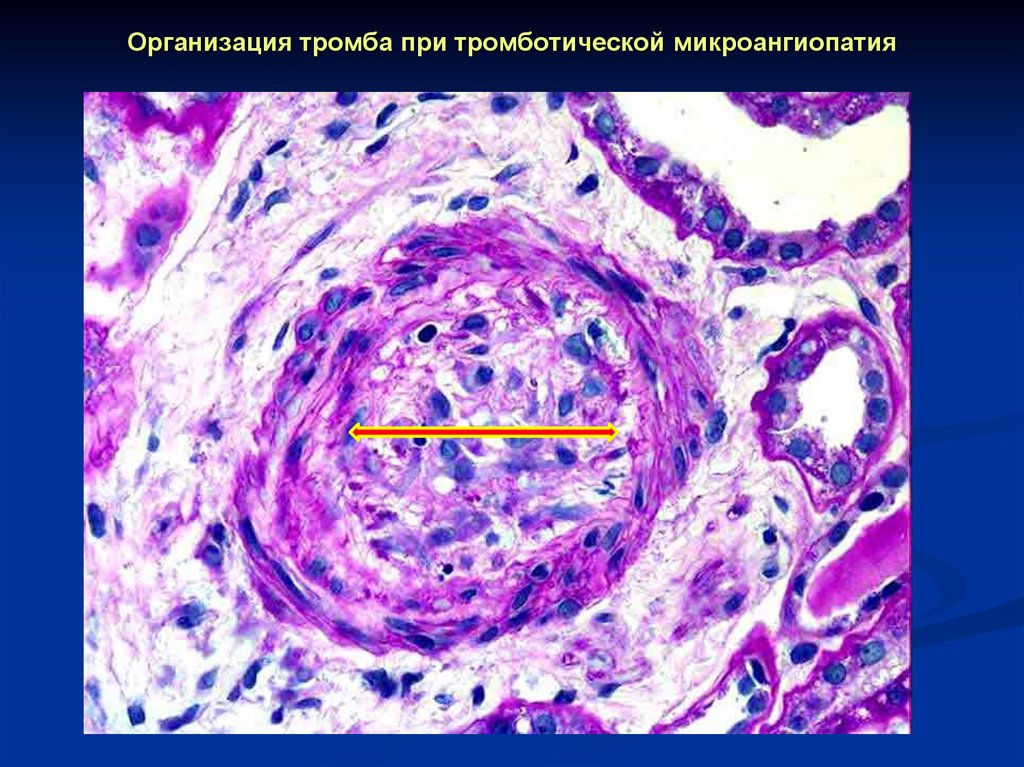 Организация тромба при тромботической микроангиопатия