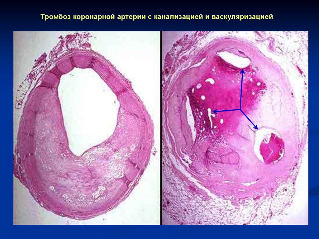 Тромбоз коронарной артерии с канализацией и васкуляризацией