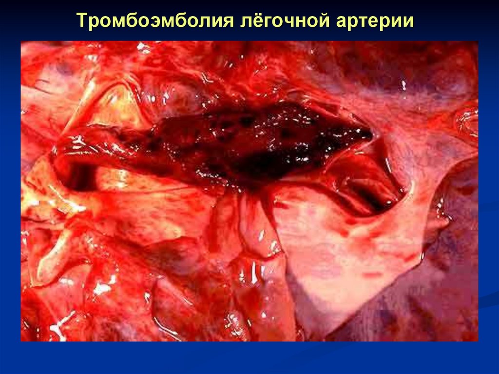 Тромбоэмболия лёгочной артерии