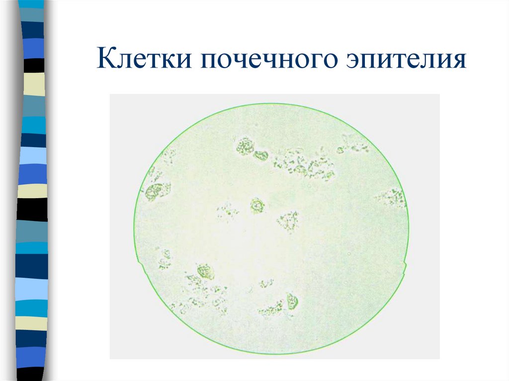 Клетки почечного эпителия в моче