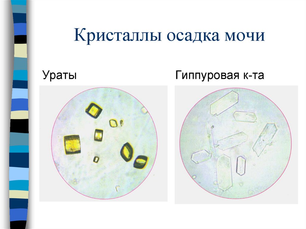 Осадки мочи