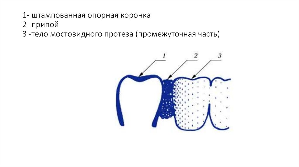 Части мостовидного протеза