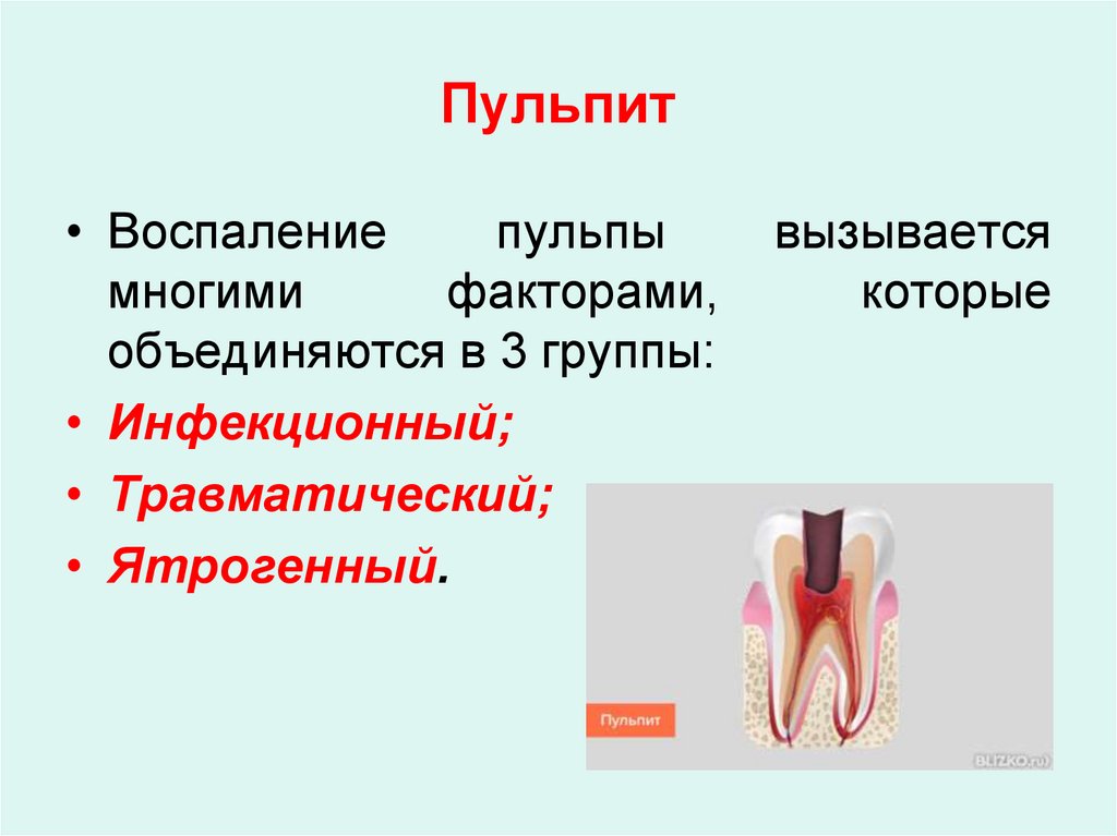 Методы лечения пульпита