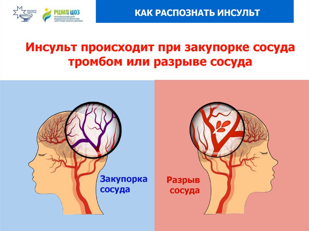 Потеря памяти при инсульте. Инсульт. Инсульт картинки.