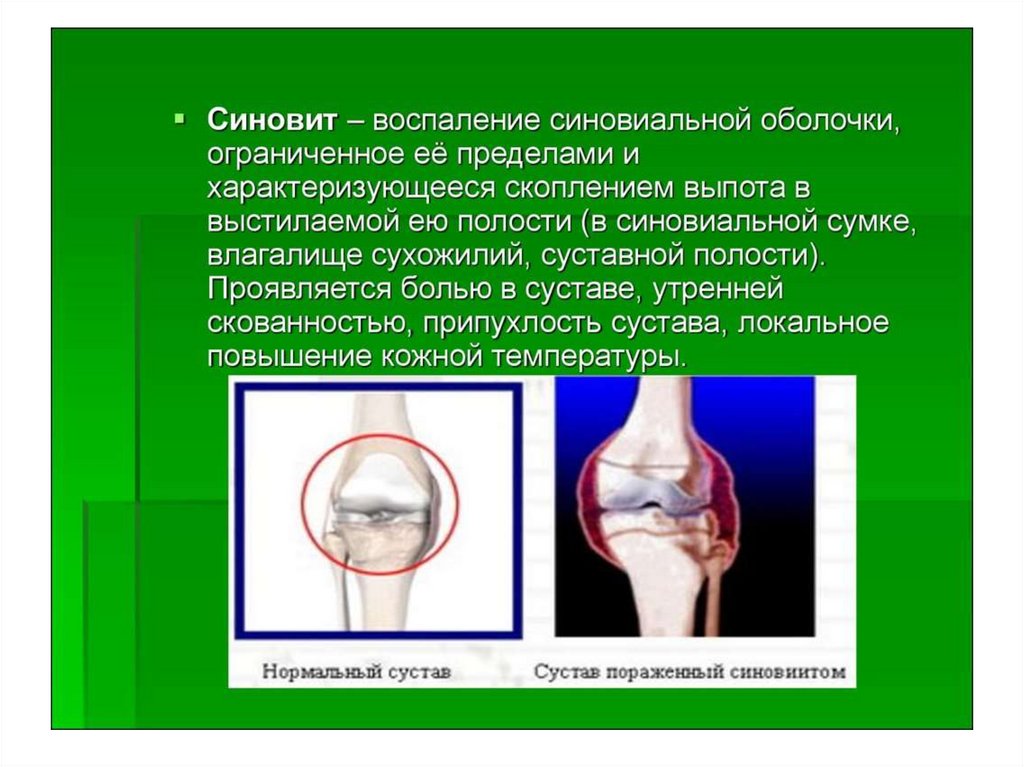 Деформациялаушы остеоартроз презентация