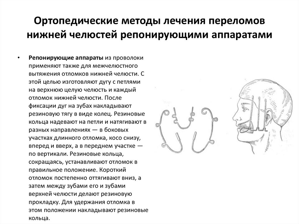 Переломы челюстей презентация