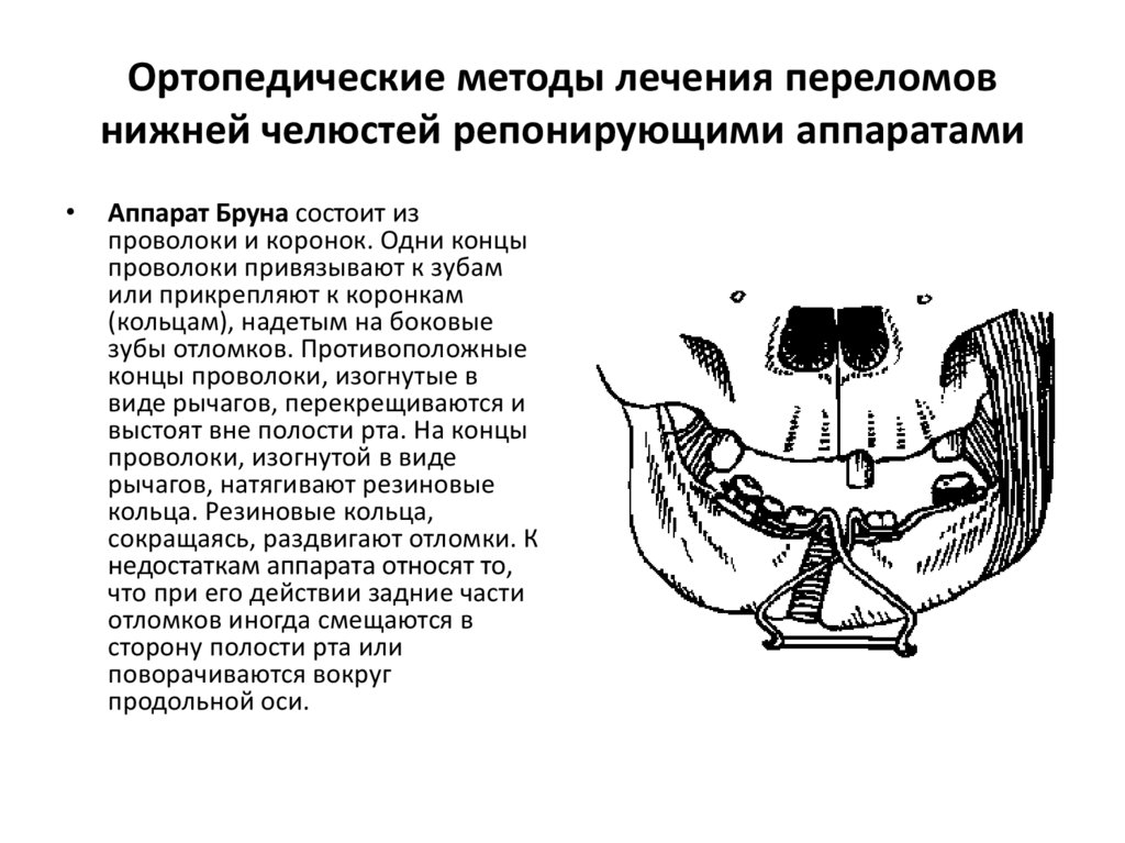 Лечение переломов презентация