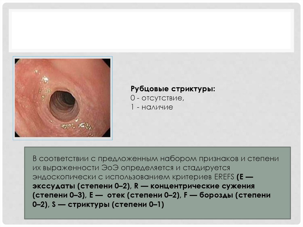 Эозинофильный эзофагит - презентация онлайн