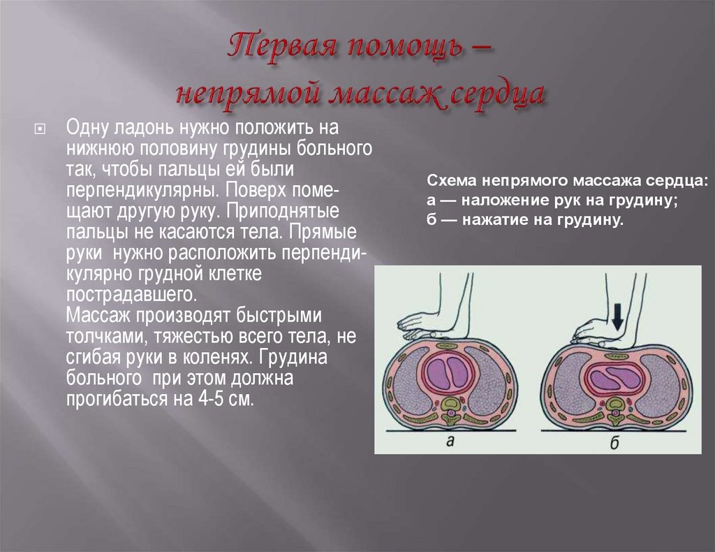 Первая помощь – непрямой массаж сердца