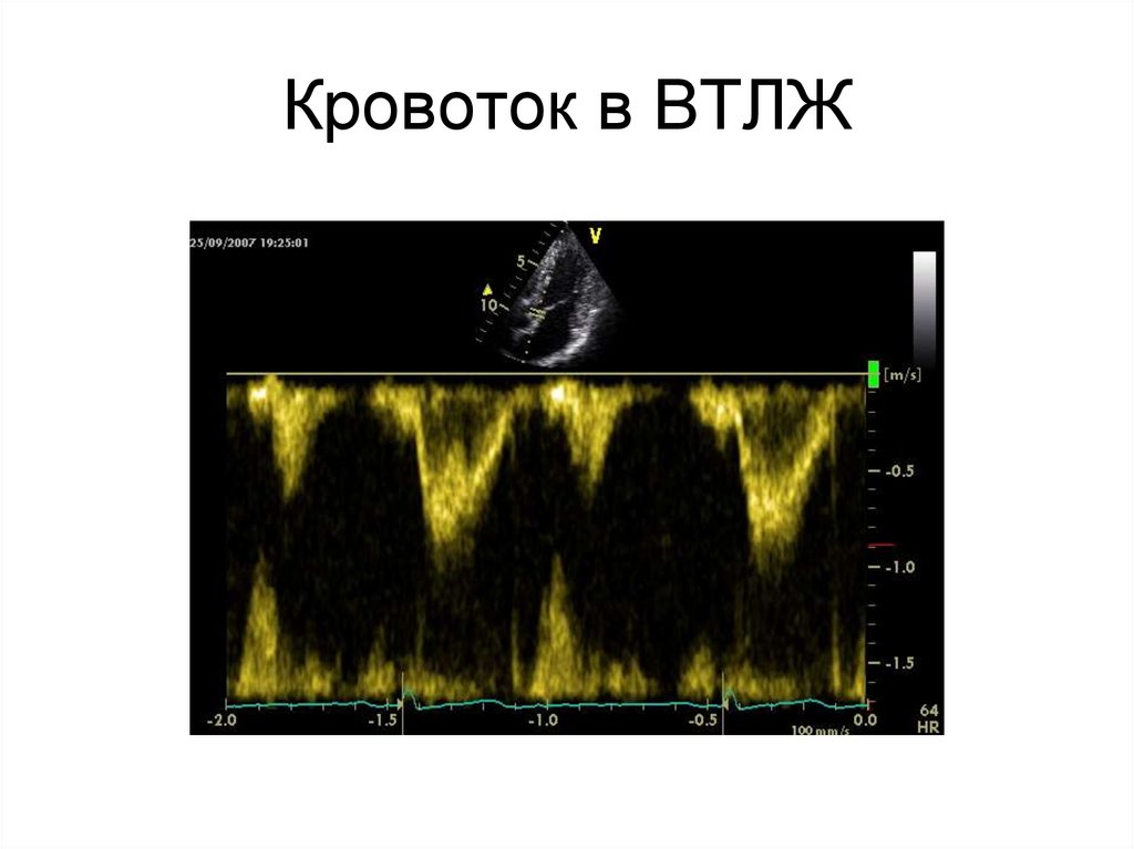 Кровоток в ВТЛЖ