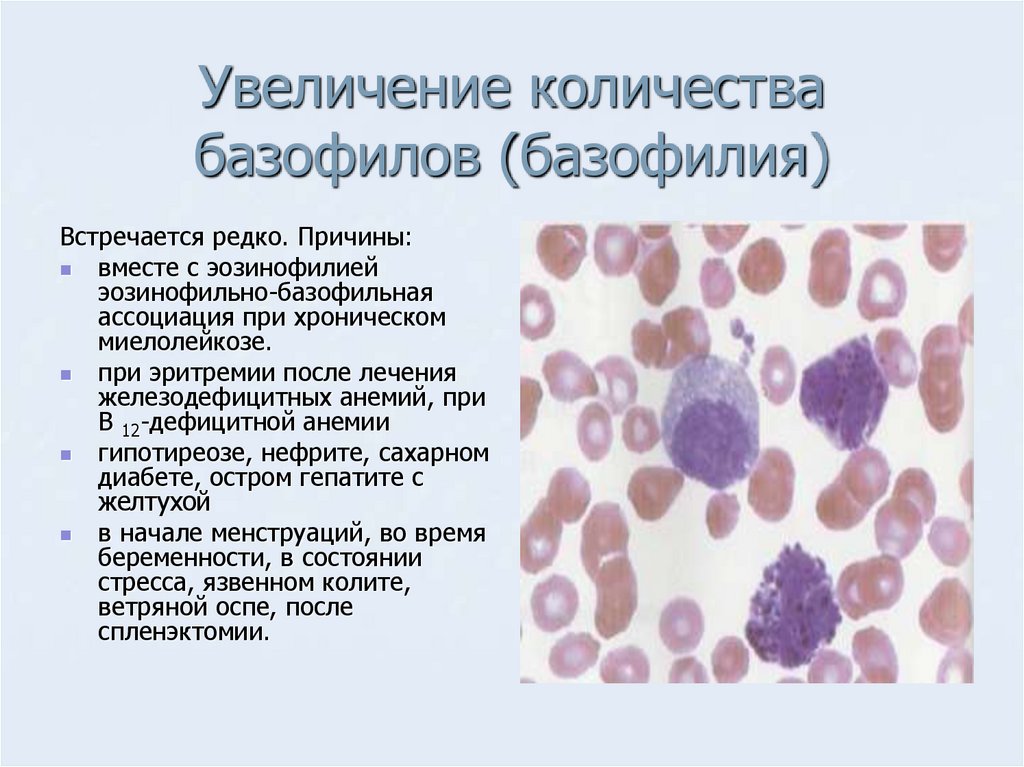 Клетка с базофильной цитоплазмой. Причины и механизмы развития эозинофилий и Базофилий.. Эозинофильно базофильная Ассоциация при миелолейкозе. Число клеток в 1 мм3 крови базофилы. Базофилия гемограмма.