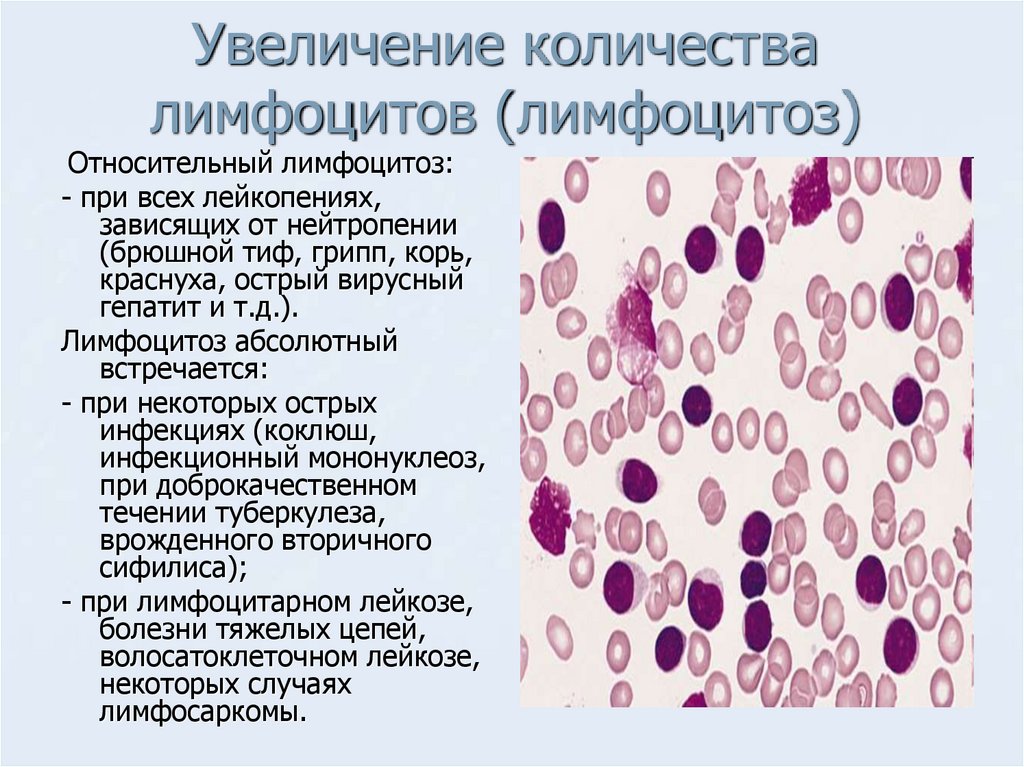 Снижение лейкоцитоза. В -лимфоциты хронический лимфолейкоз. Картина крови при лимфоцитозе. Картина крови при инфекционном лимфоцитозе. Повышен относительный лимфоцитоз.