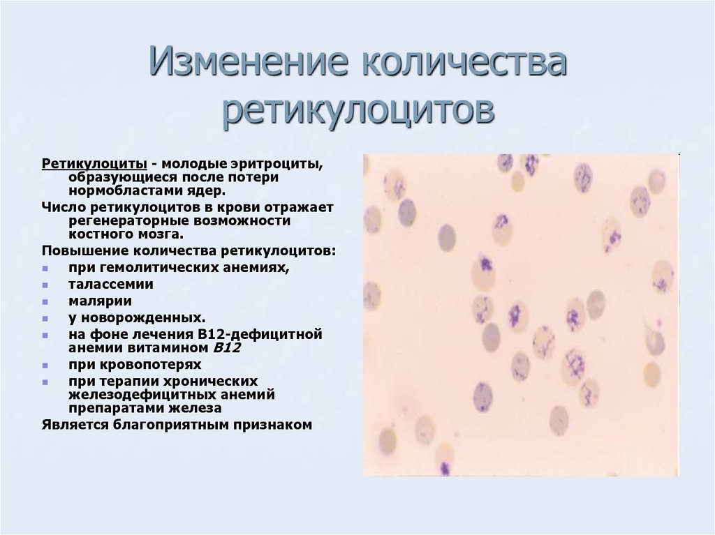 Повышение ретикулоцитов в крови. Ретикулоциты в периферической крови. Ретикулоциты мазок крови. Уровень ретикулоцитов при гемолитической анемии. Ретикулоциты анализ крови анемия.