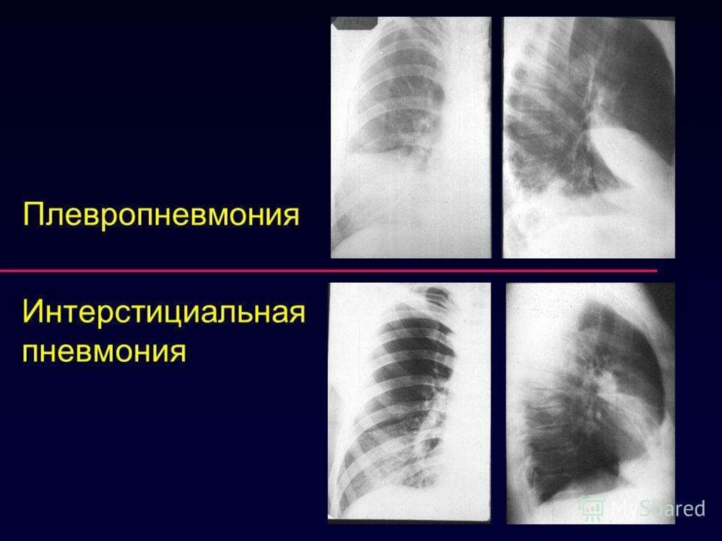 Двусторонняя пневмония. Рентген пневмококковой крупозной пневмонии. Интерстициальная пневмония рентген. Плевропневмония (крупозная) пневмонии. Интерстициальная пневмония крупозная.