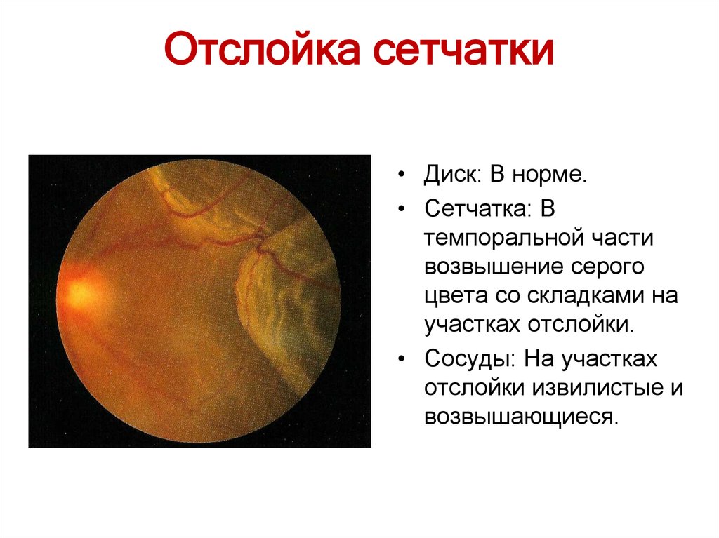 Отслойка сетчатки причины. Отслойка сетчатки глаза офтальмоскопия. Первичная и вторичная отслойка сетчатки. Неопластическая отслойка сетчатки. Первичная отслойка сетчатки этиология.