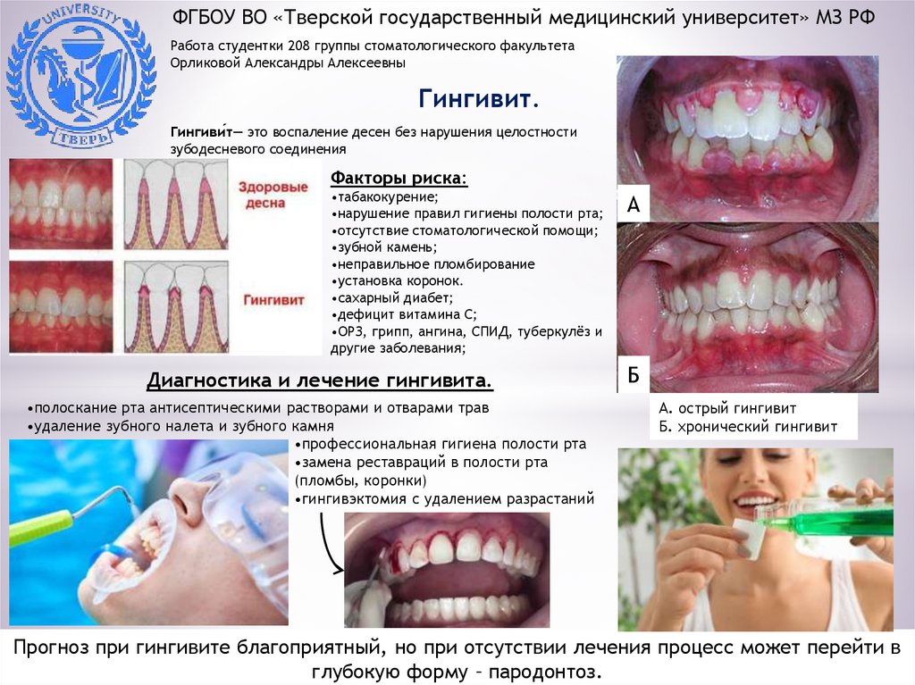Гингивит. Виды - online presentation