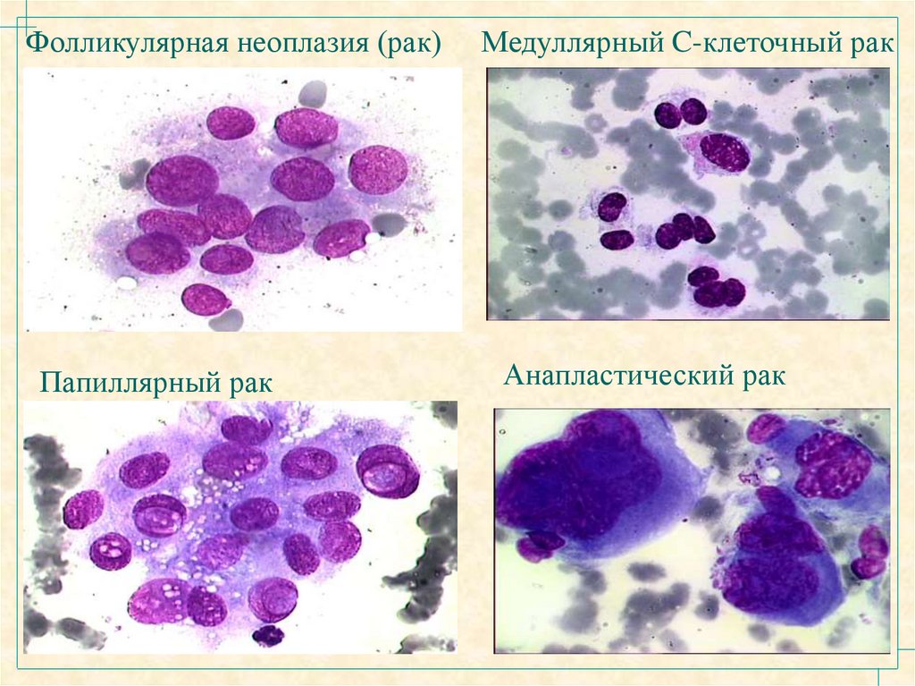 Медуллярный рак. Фолликулярная аденома щитовидной железы цитология. Фолликулярная опухоль цитология. Цитологическая картина фолликулярной опухоли. Фолликулярная неоплазия.