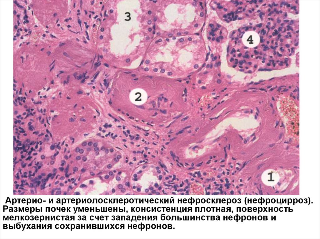 Атеросклероз дистрофия. Гидропическая дистрофия эпителия канальцев почки. Нефросклероз патологическая анатомия. Атеросклеротический нефросклероз почки. Гиалиноз сосудов гистология.