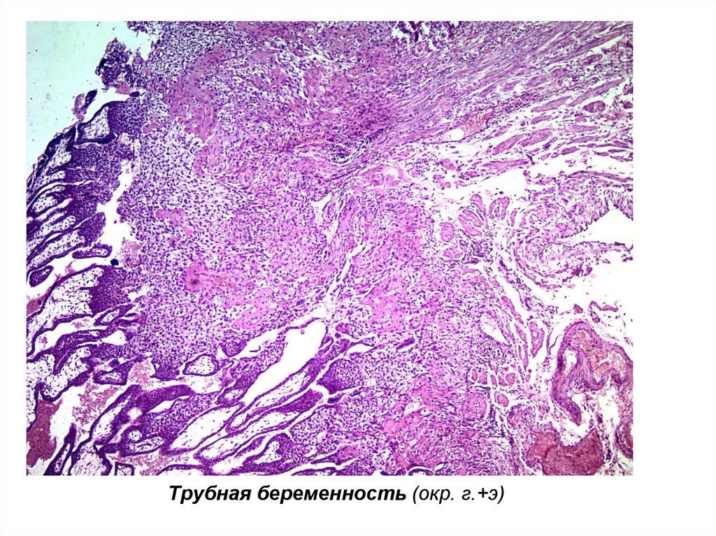 Трубная беременность микропрепарат рисунок