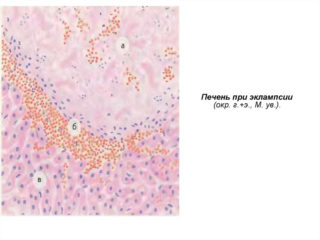 Печень при эклампсии микропрепарат рисунок