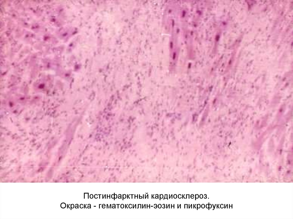 Кардиосклероз рисунок микропрепарат