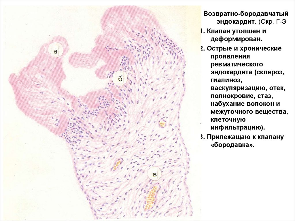 Ревматический миокардит микропрепарат рисунок