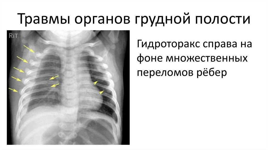 Множественные переломы ребер карта вызова