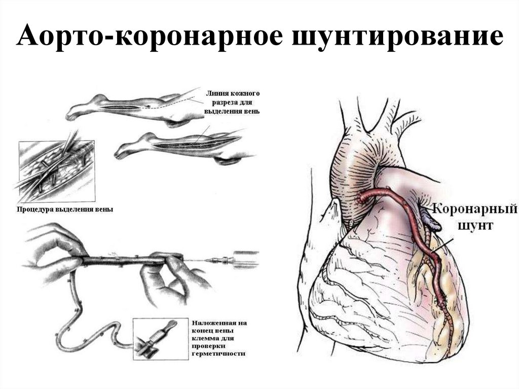 Поставили шунты. Схема операции аортокоронарного шунтирования. Коронарное шунтирование сосудов сердца. Аортокоронарное шунтирование топографическая анатомия. Шунтирование коронарных артерий схема.