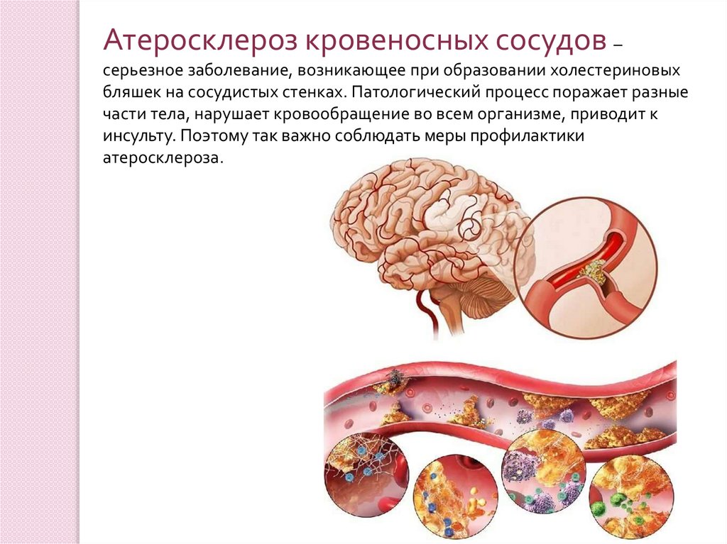 Атеросклероз причины