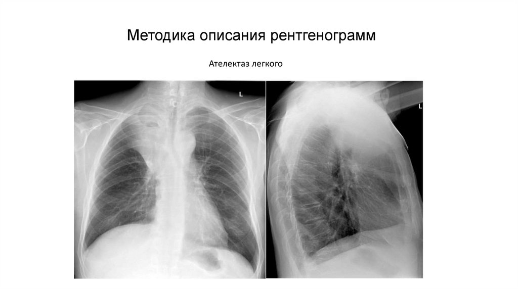 Лучевая диагностика заболеваний легких презентация