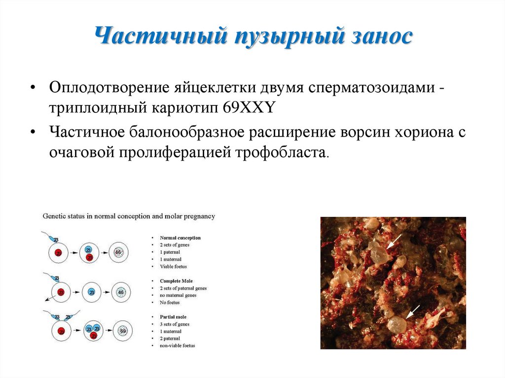 Пузырный занос рекомендации