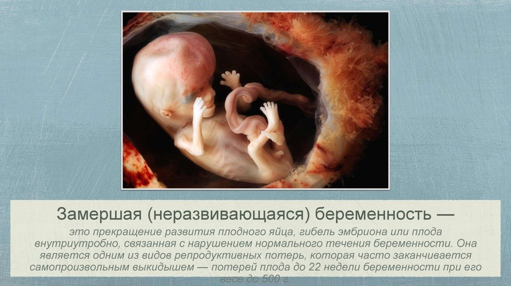 Внутриутробное замирание плода - online presentation