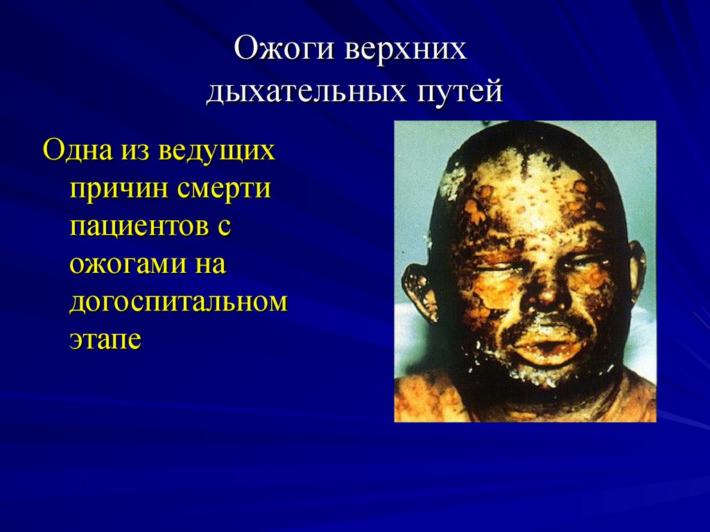 Ожоги верхних дыхательных путей