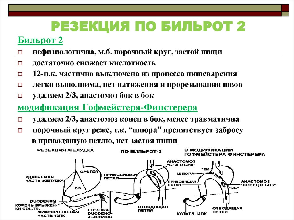 Операции по бильрот 1 и 2 схема