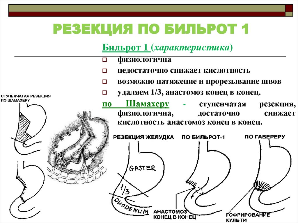 Бильрот 1 и 2 отличия схема