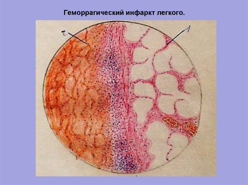 Хроническое венозное полнокровие печени микропрепарат рисунок