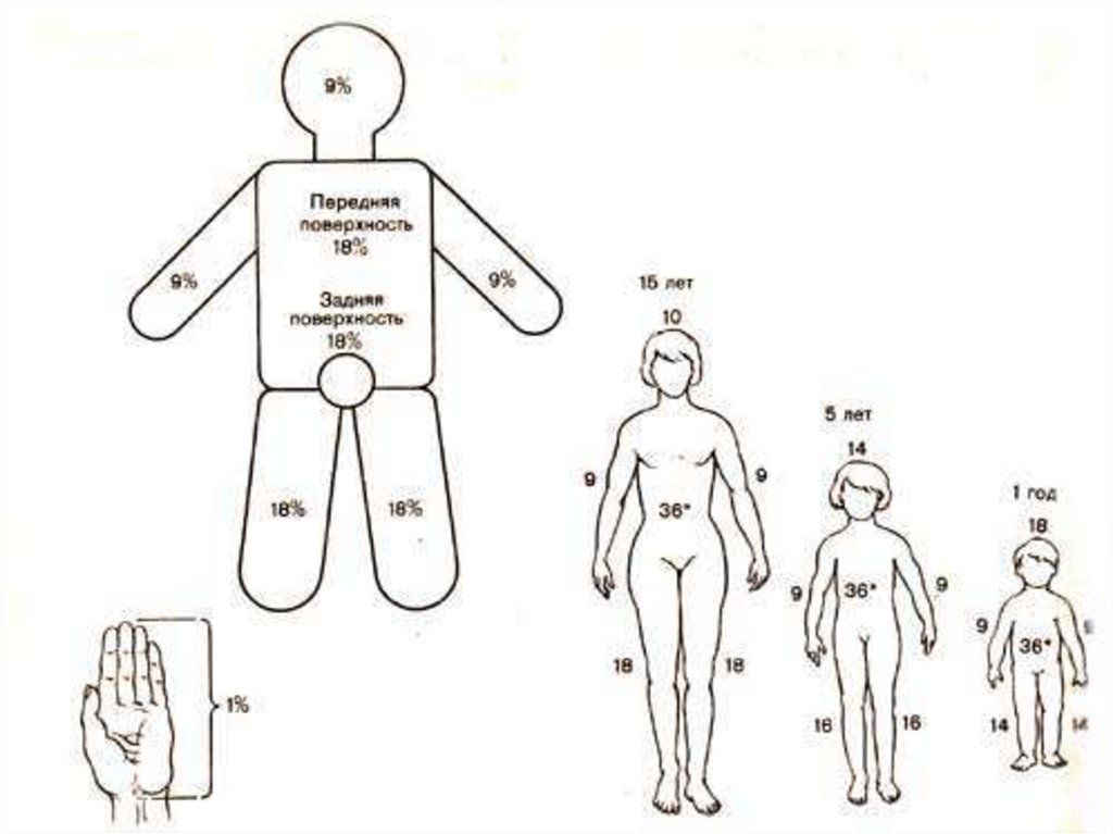 Площадь поражения. Правило 9 при ожогах у детей. Правило девяток у детей. Площадь ожога головы и шеи составляет в процентах. Площадь ожога поверхности тела каждая нога у детей 5 лет составляет.