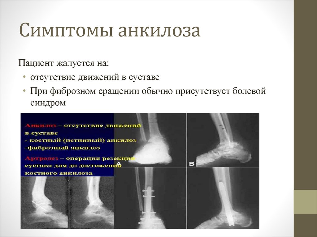 Анкилоз - online presentation
