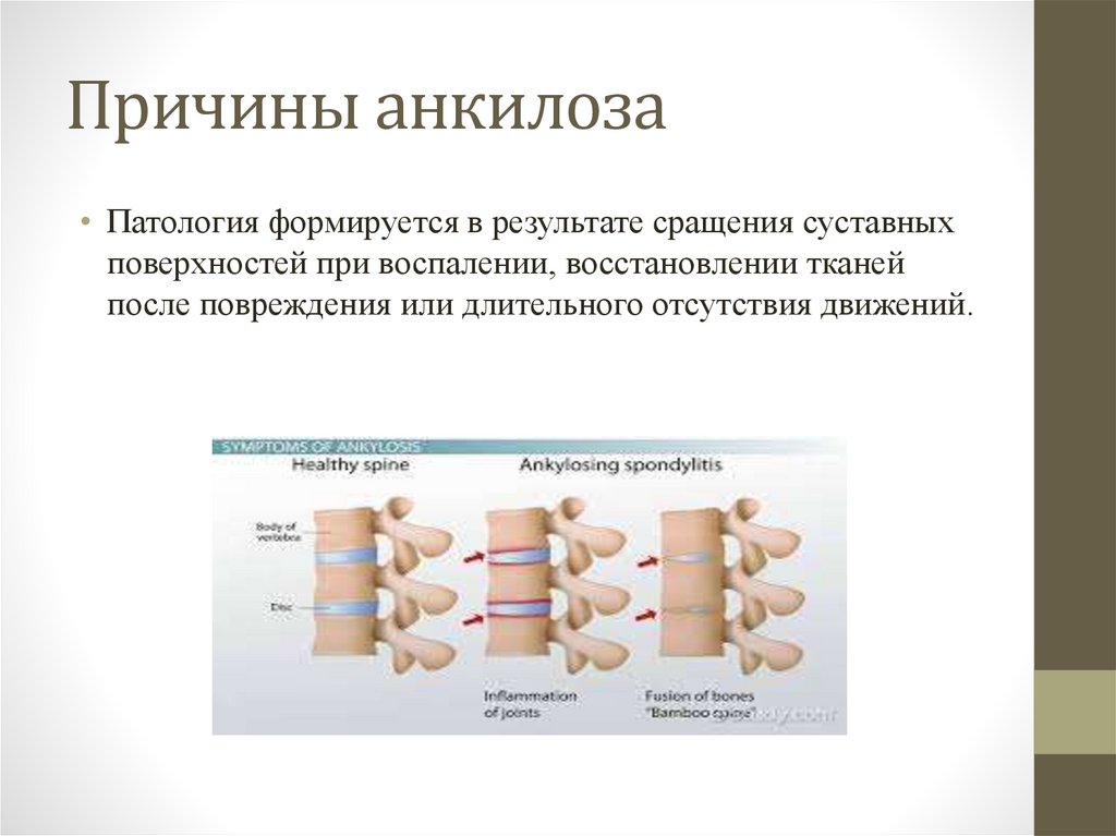 Анкилоз - online presentation