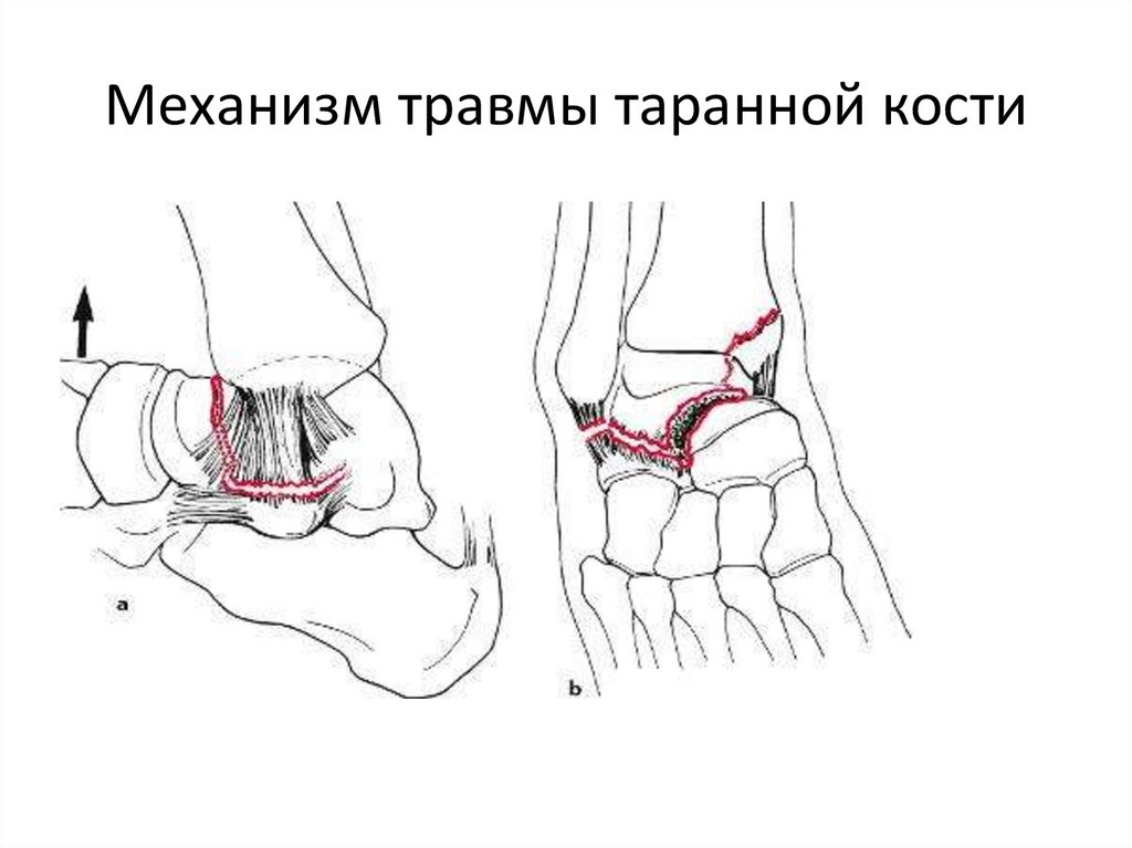 Перелом пяточной кости карта вызова